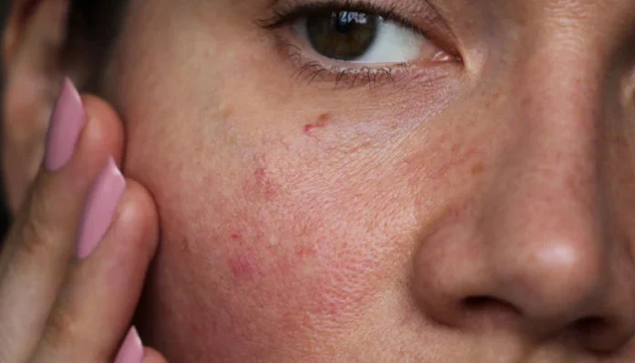 rosacea_blog_57876873-109b-4ebd-a1b0-71c237d040a7